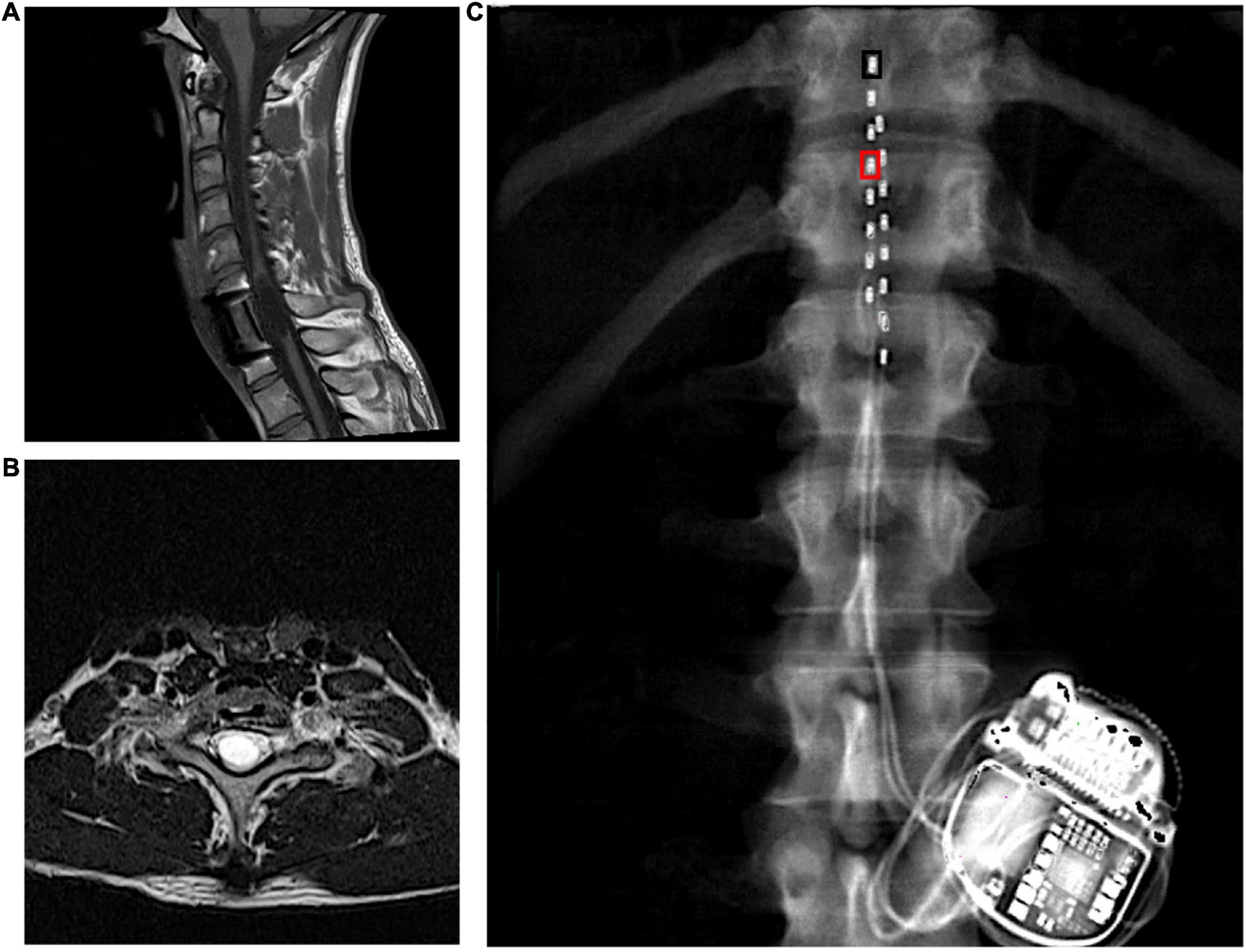 Effects of percutaneously-implanted epidural stimulation on cardiovascular autonomic function and spasticity after complete spinal cord injury: A case report